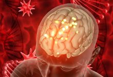 O que é aneurisma cerebral?