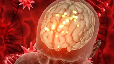 O que é aneurisma cerebral?