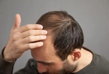O que causa a alopecia